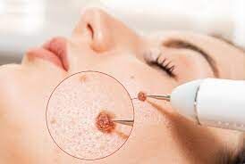 Say No to Home Remedies for Warts – A Real Case of Preventable Skin Damage in Hubli
