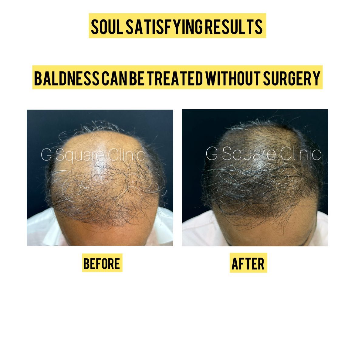 restoring-confidence-without-surgery-a-success-story-in-male-pattern-baldness-by-dr-girishkumar-chalawadi-thumbnail