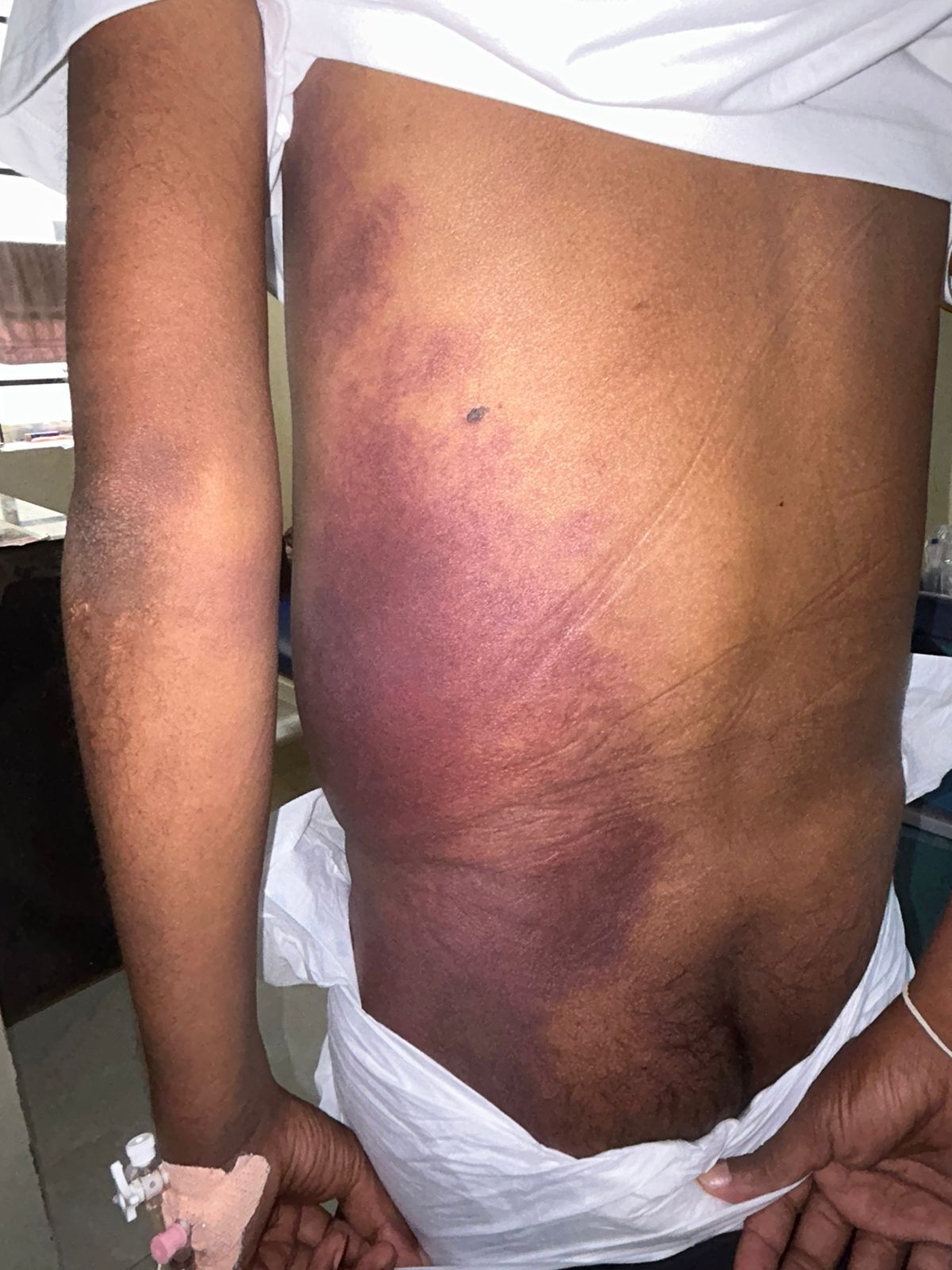 spotting-a-serious-health-warning-on-your-skin-grey-turners-sign-thumbnail