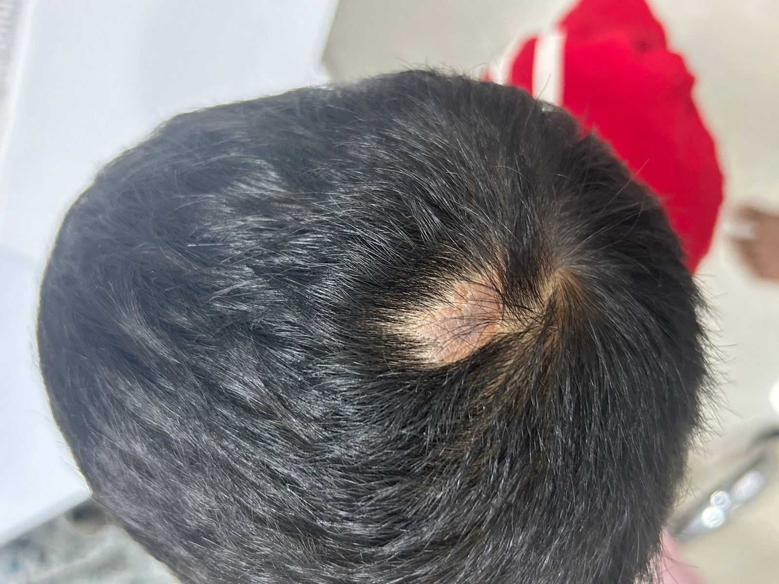 Understanding Nevus Sebaceous: Causes, Risks, and Treatment Options