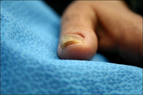pincer-nail-deformity--restoring-comfort-through-surgical-precision-at-g-square-clinic-thumbnail