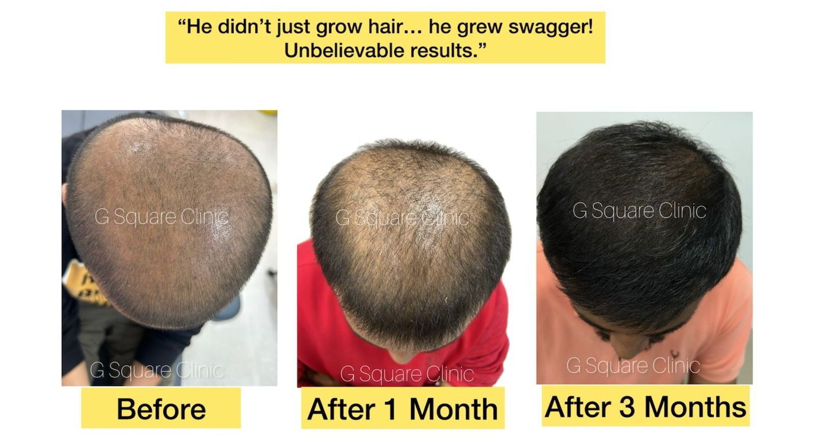 from-balding-to-bold-remarkable-hair-regrowth-after-gfc--microneedling-at-g-square-clinic-thumbnail