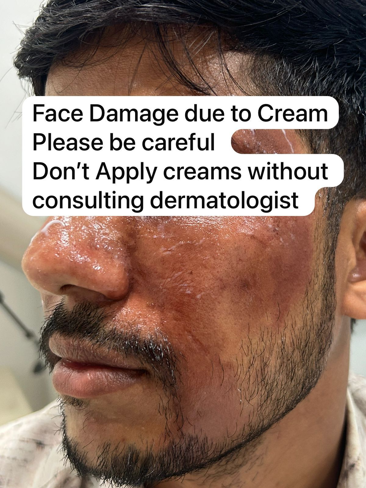 stop-using-online-or-pharmacy-creams-without-dermatologist-advice--it-can-permanently-damage-your-skin-thumbnail