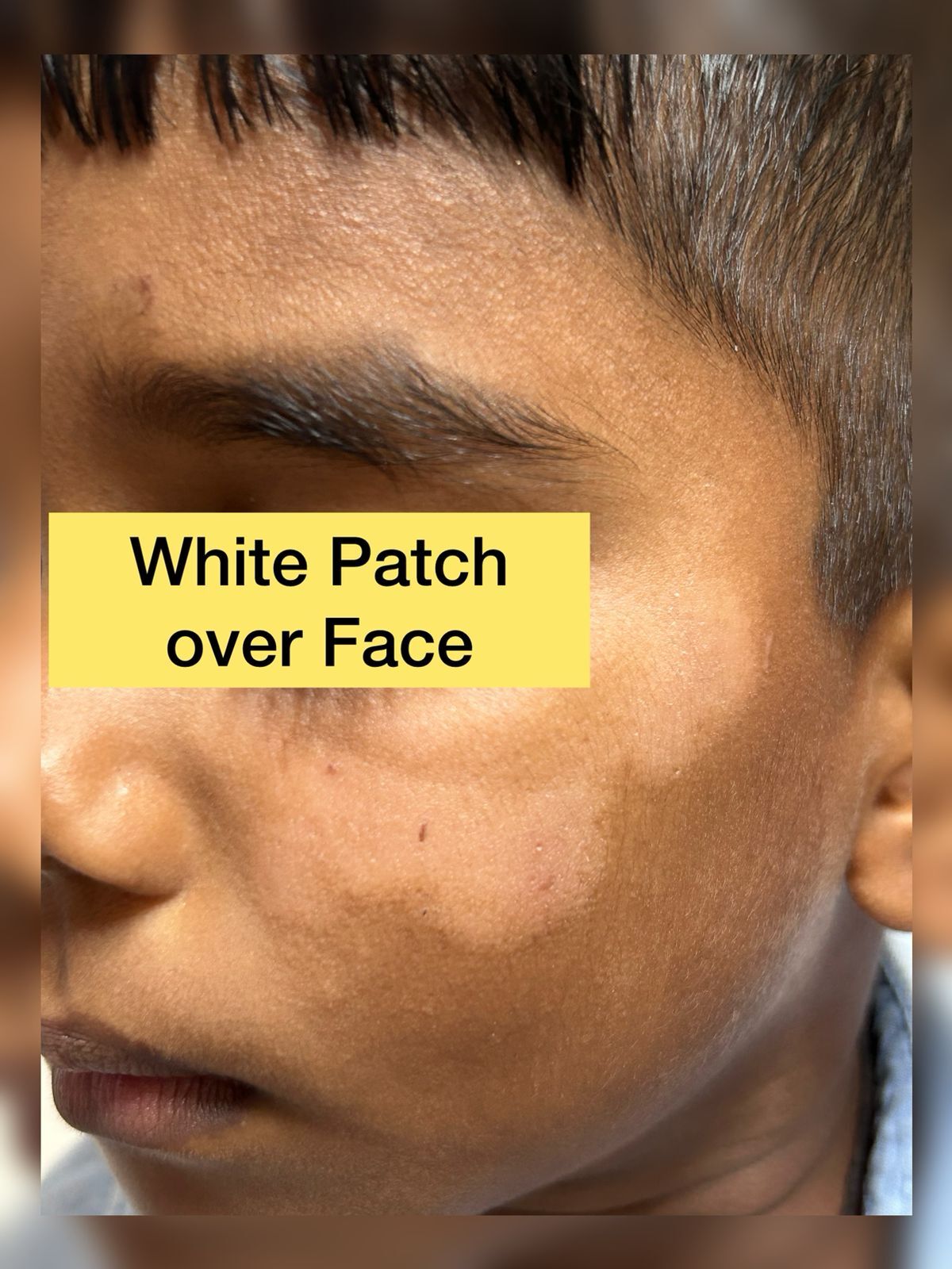 case-of-pityriasis-alba-in-a-child--understanding-the-common-white-patch-condition--by-dr-girishkumar-m-chalawadi-thumbnail