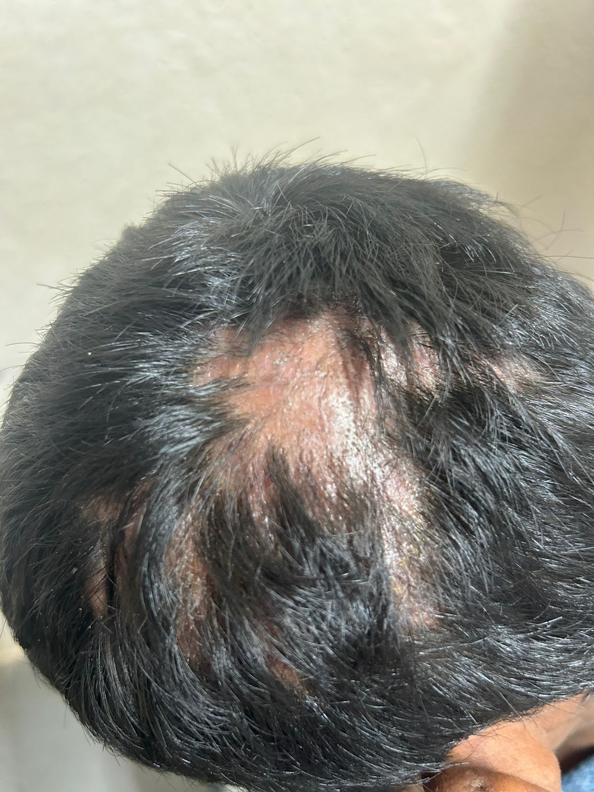 Understanding Patchy Hair Loss in Children: A Parent’s Guide By Dr. Girishkumar Chalawadi