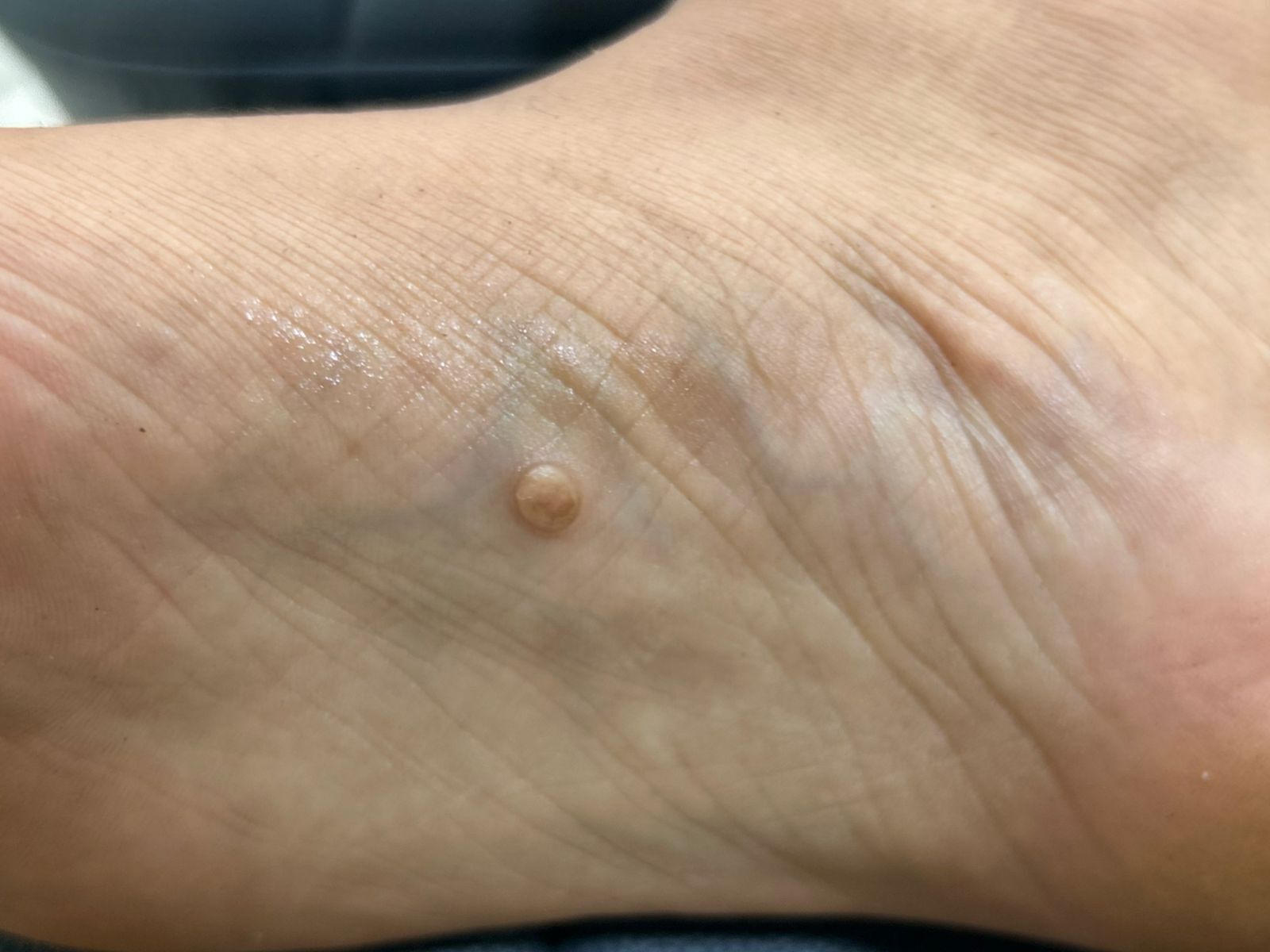 Painful Lump on the Sole – Could It Be a Dermatofibroma? By Dr. Girishkumar Chalawadi
