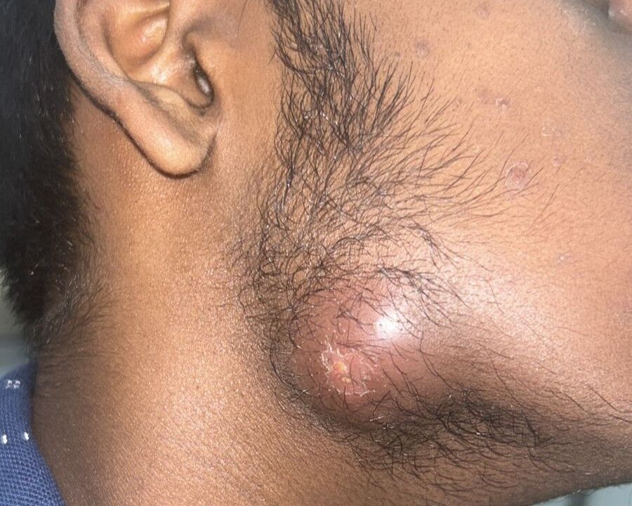 From Simple Acne to Abscess: A Neglected Case of Nodulocystic Acne By Dr. Girishkumar Chalawadi