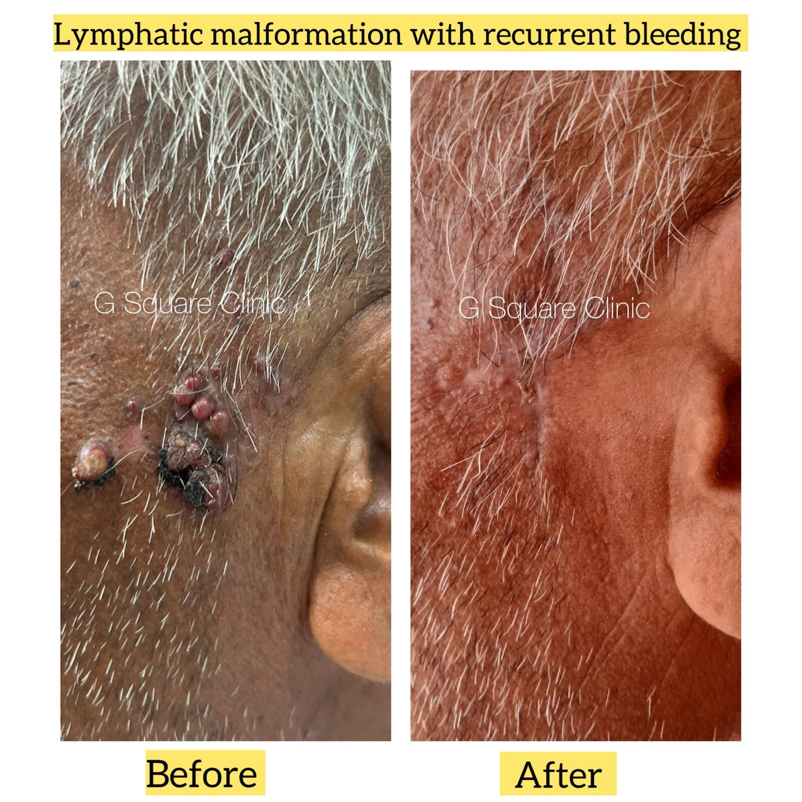 Lymphatic Malformation with Recurrent Bleeding Successfully Treated by Surgical Excision Under Sedation