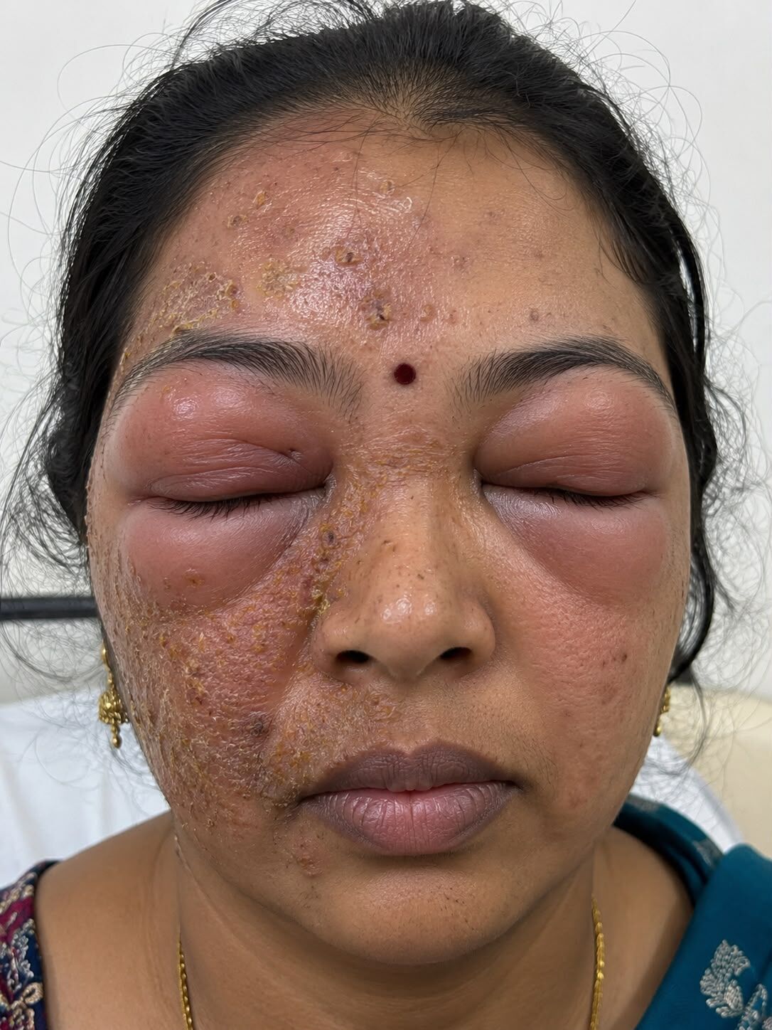 The Hidden Dangers of “Barsodhu”: Why Applying Soda Lime on Skin Diseases Can Cause More Harm Than Good  By Dr. Girish Kumar M. Chalawadi, MD (Dermatology) G Square Skin, Hair & Plastic Surgery Clinic, Hubli