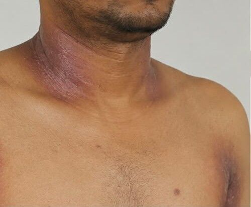 Dermatologist in Hubli for Recurrent Skin Rashes – Dr. Girish Kumar Chalawadi Diagnoses Hailey-Hailey Disease