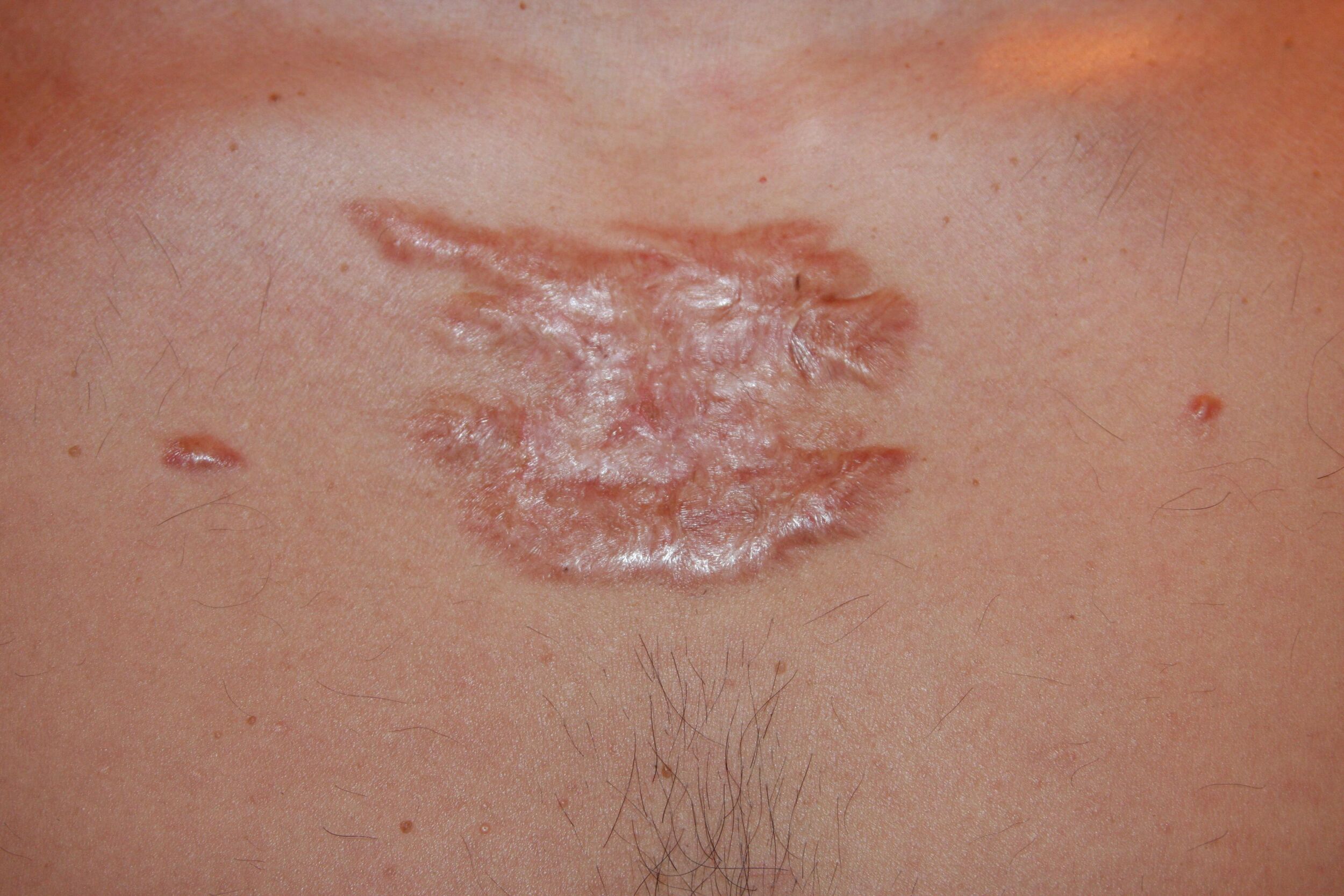 Keloid Treatment in Hubli – Presternal Keloid with Pyogenic Granuloma Treated Using ILRF-A