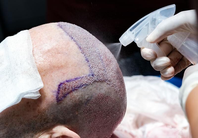 Hair Transplant in Hubli – Top Recovery Tips for Healthy Hair Growth